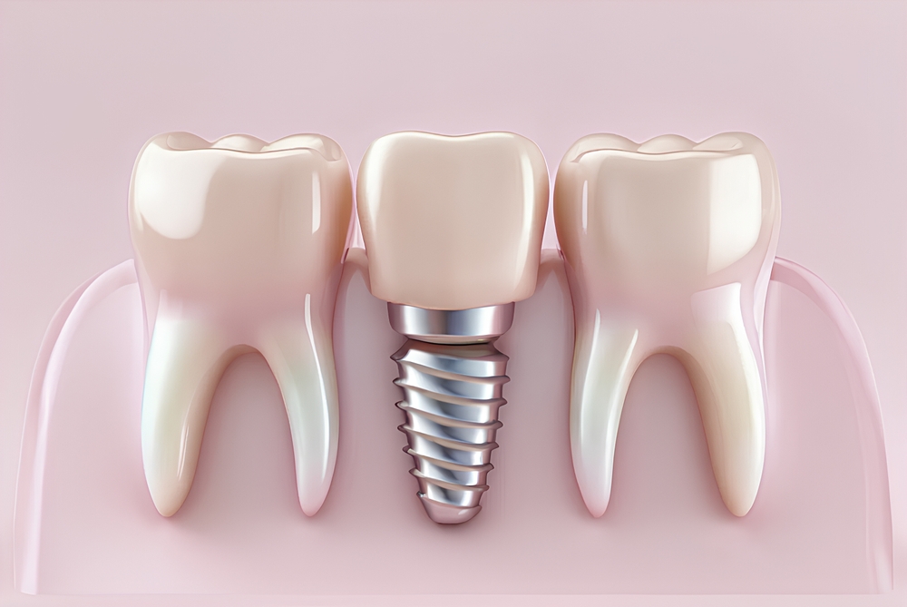 dental implant surrey